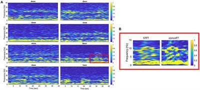 Theta Oscillations at Subthalamic Region Predicts Hypomania State After Deep Brain Stimulation in Parkinson's Disease